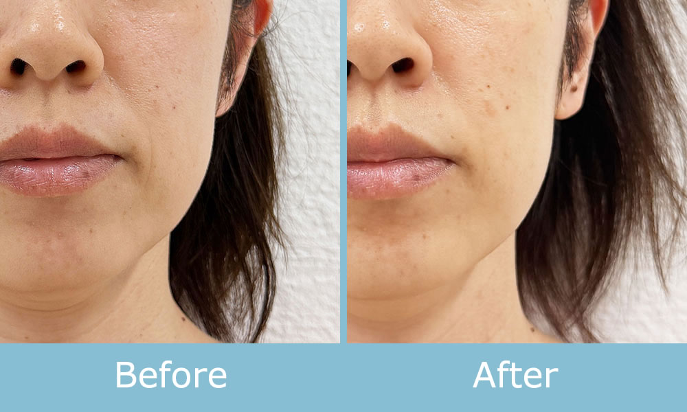 ソフトダーマ 施術例 ビフォーアフター01