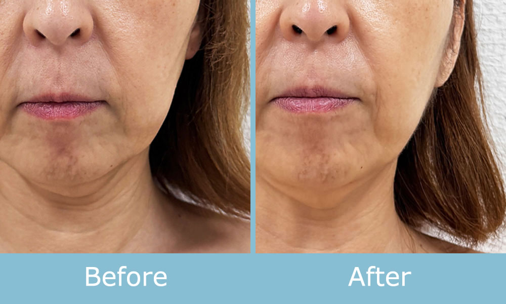 ソフトダーマ 施術例 ビフォーアフター02