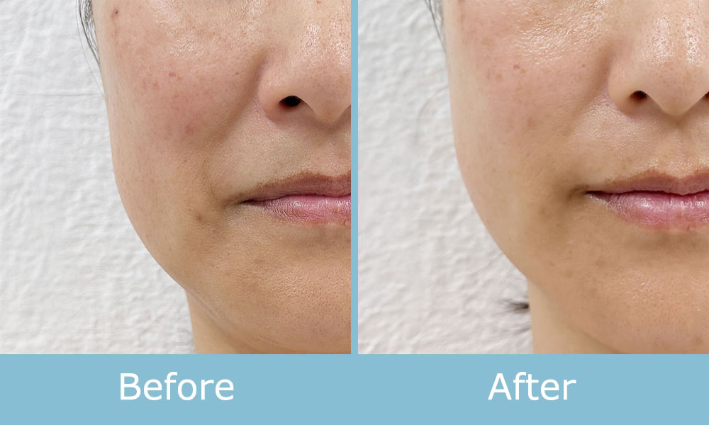 ソフトダーマ 施術例 ビフォーアフター03