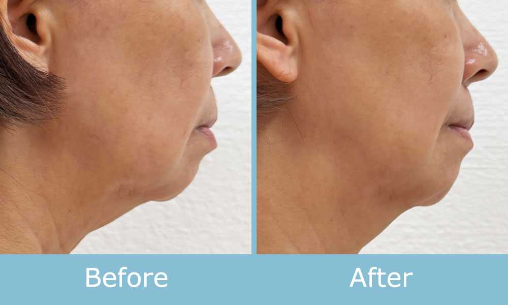 ソフトダーマ 施術例 ビフォーアフター04