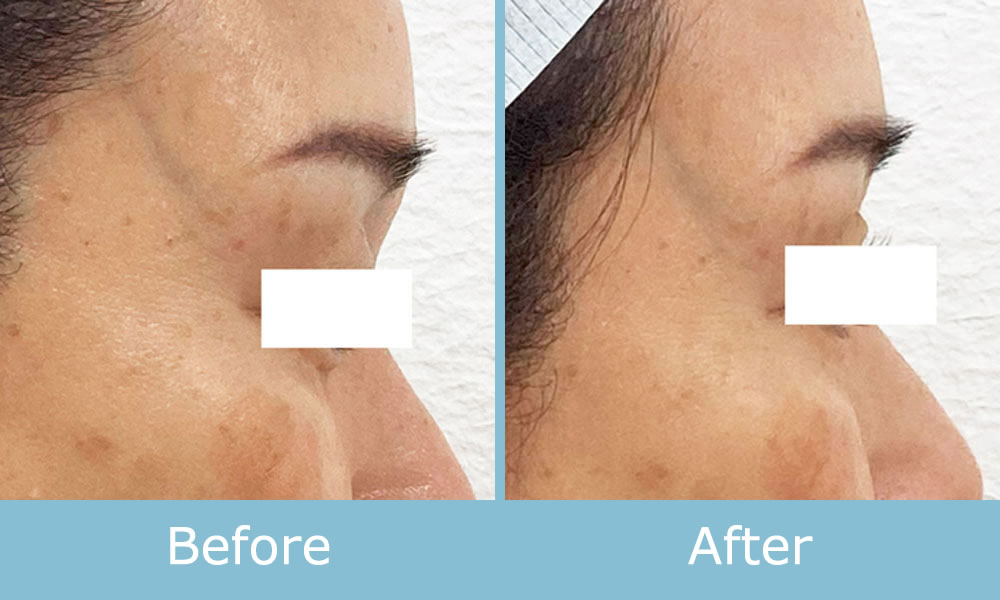 ソフトダーマ 施術例 ビフォーアフター05